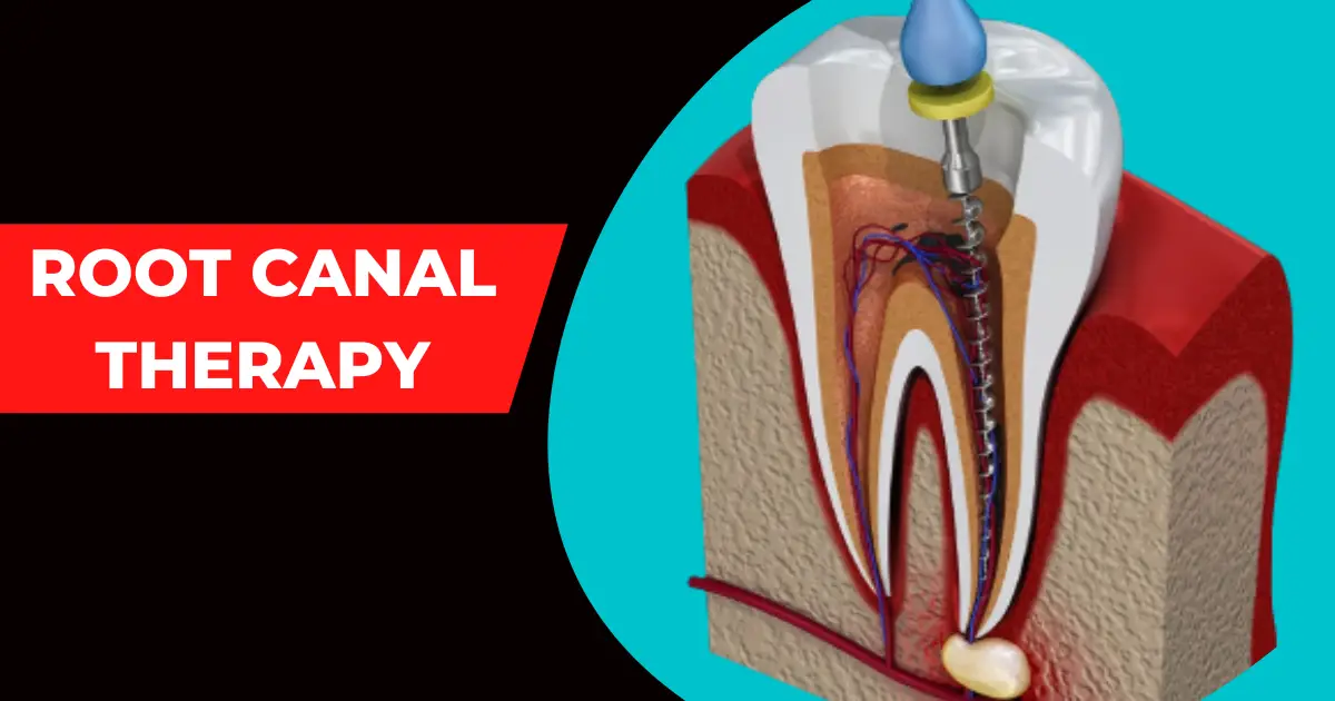 Root Canal Therapy | Endodontic Treatment | Know It